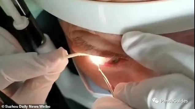 Man who has live worms on his eyes undergo a surgery.